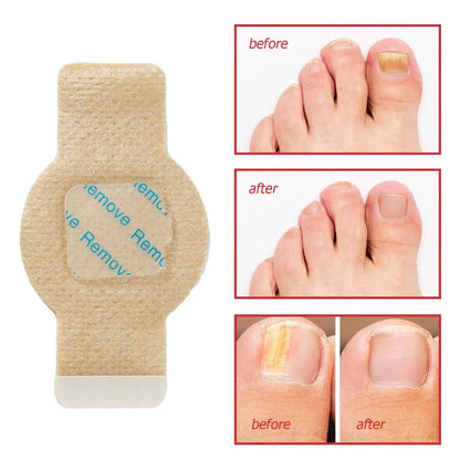 Fungal Nail Patches